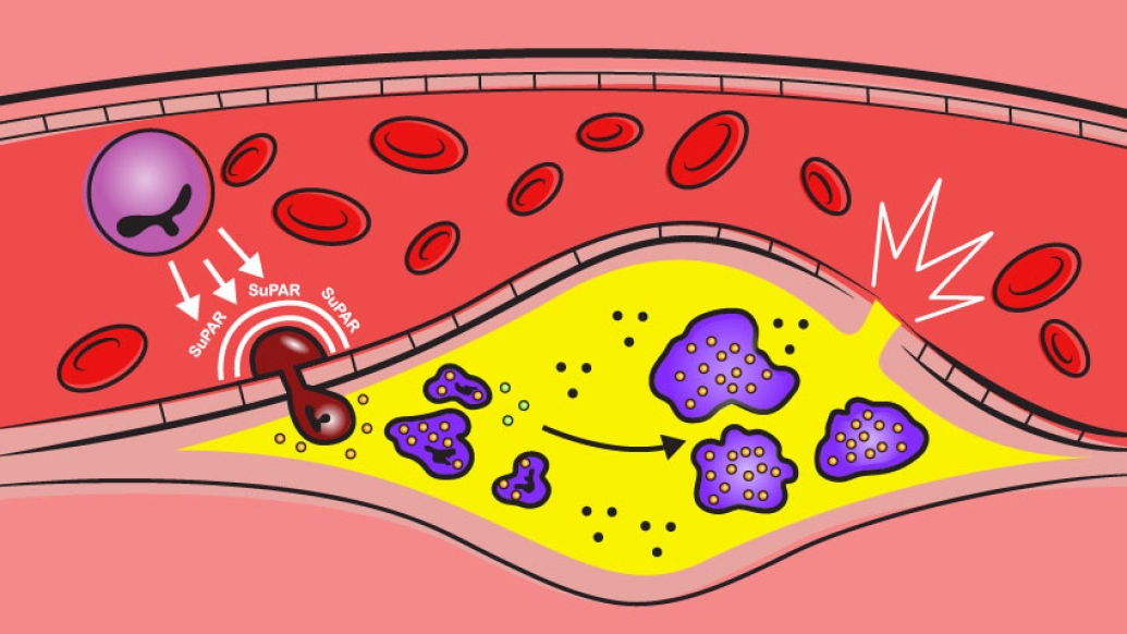 suPAR cells enter the blood vessel wall and accelerate the development of atherosclerosis