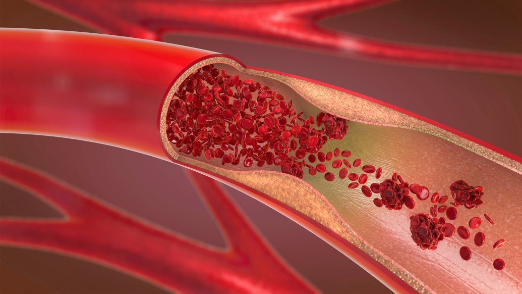 Vein-Red-Blood-Cells-Plaque.jpg