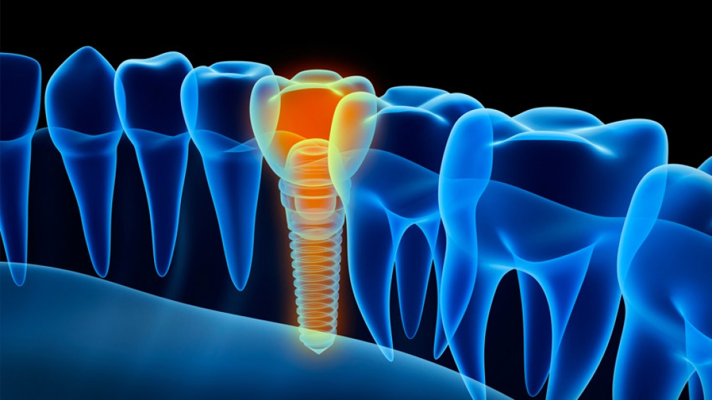 graphic of a yellow screw instead of a blue outlined tooth in an xray