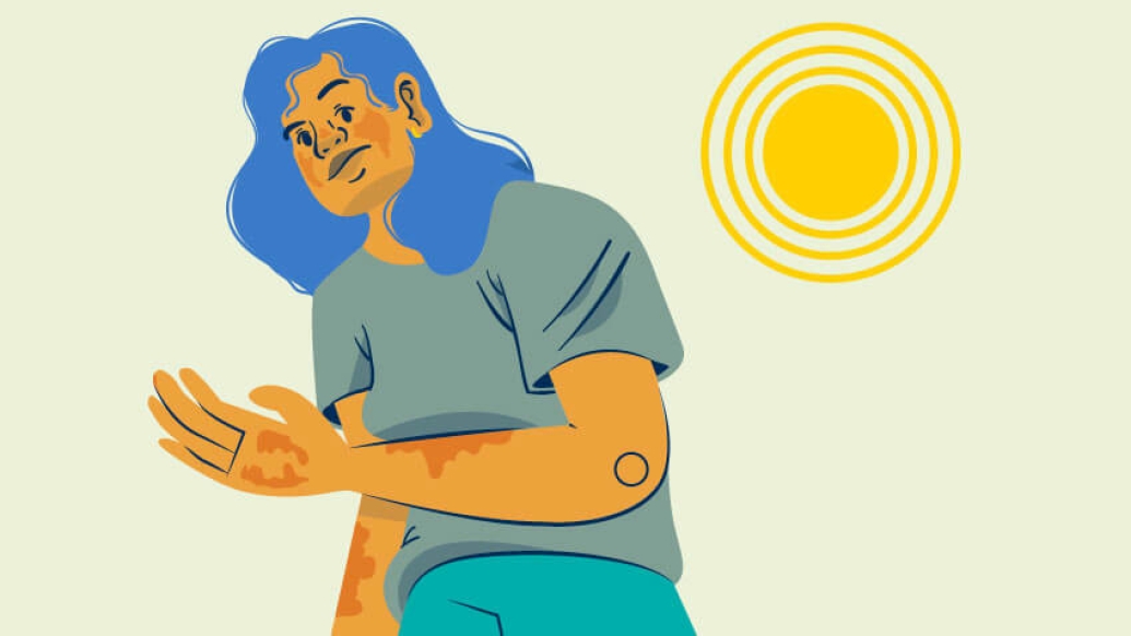 Person standing in the sun in blue with skin rash