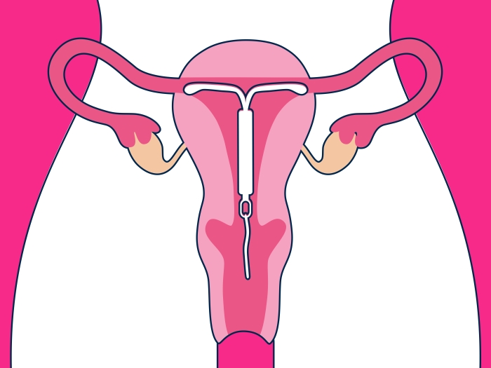 uterus pink background white body outline seeing white IUD