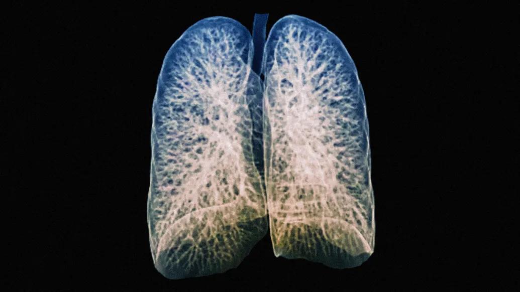 A CT scan of healthy lungs