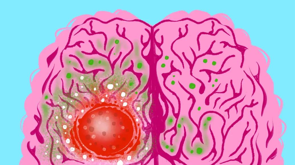Dietary changes could provide a therapeutic avenue for brain cancer ...