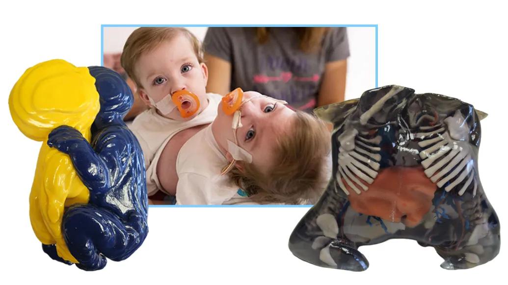 Conjoined twins with 3D models