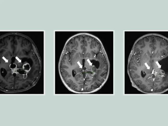 glioma brain scan