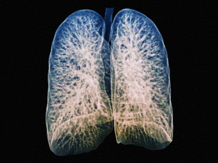 A CT scan of healthy lungs