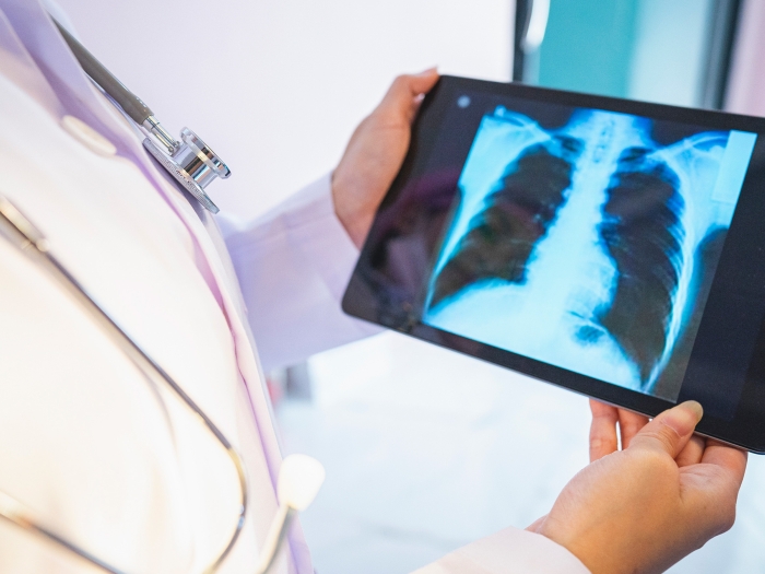 xray on tablet held by clinician in white coat and stethoscope 