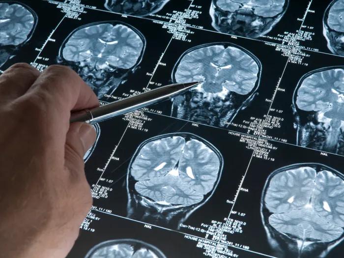 xray brain images on repeat and person pointing with pointer