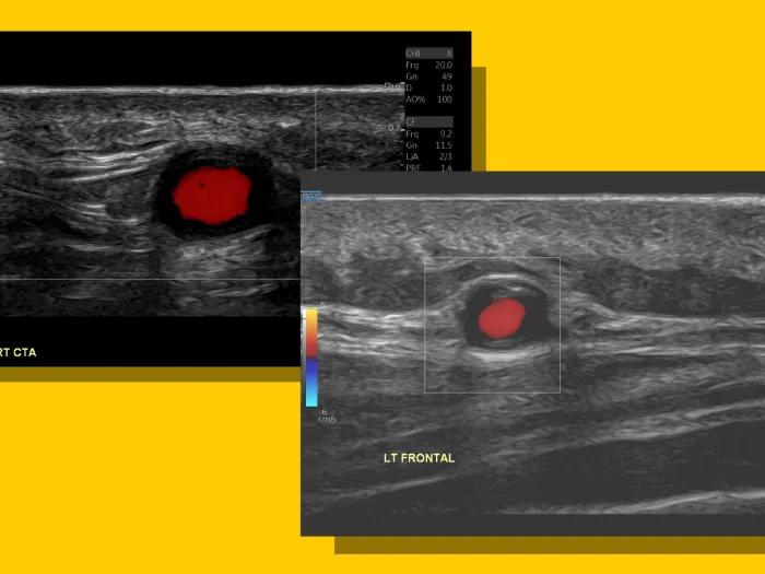 ultrasound scan on yellow background with red dot found in two images