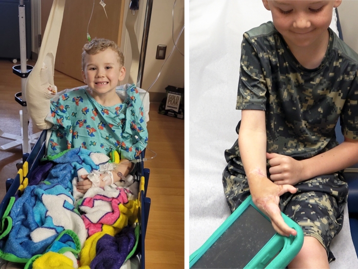 kid in wheel chair smiling and then on right is hand reconstructed