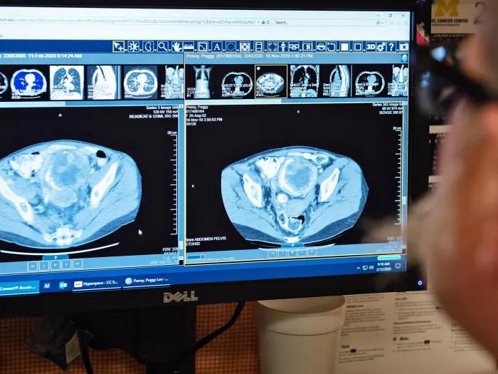 Image of a CT scan of an abdomen/pelvis
