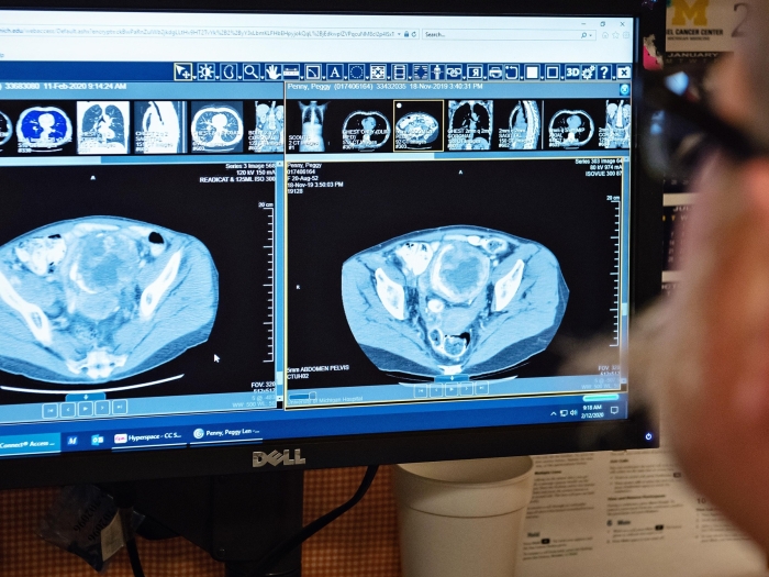 Image of a CT scan of an abdomen/pelvis