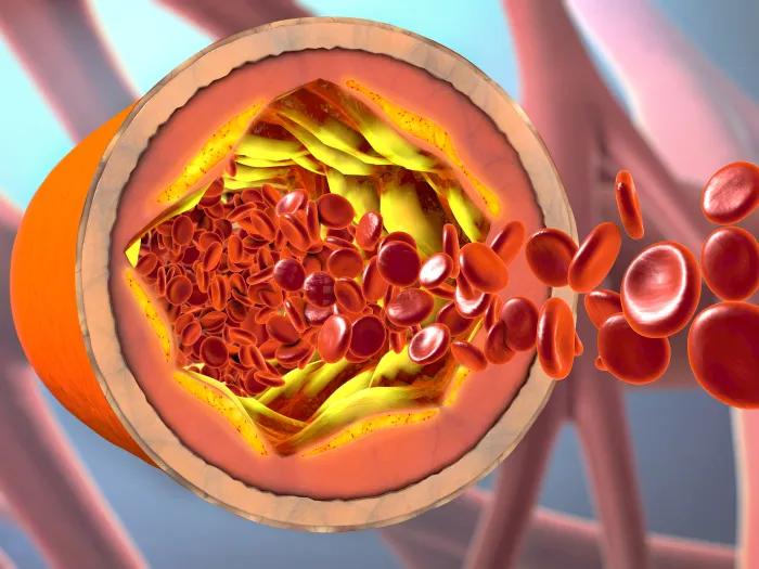 Giant Cell Arteritis