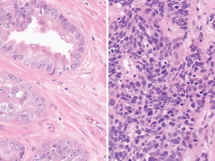 Microscope images of prostate cancer cells