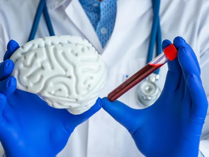 Close-up of a clinician holding a foam model of a brain and a vial with a blood sample