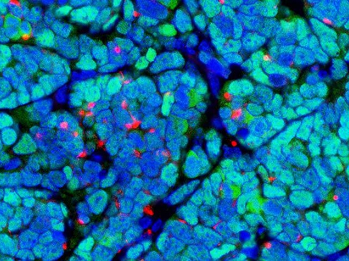 microscopic tumor cellular blue green