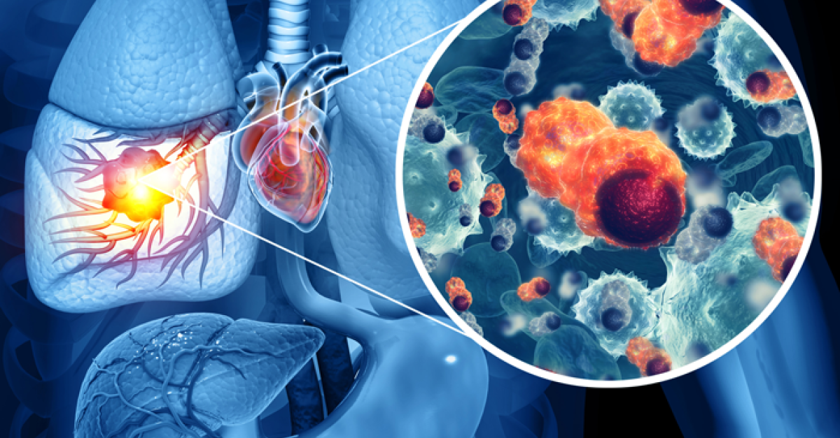 CME Event - Advances in the Treatment of Stage III Non-Small Cell Lung ...